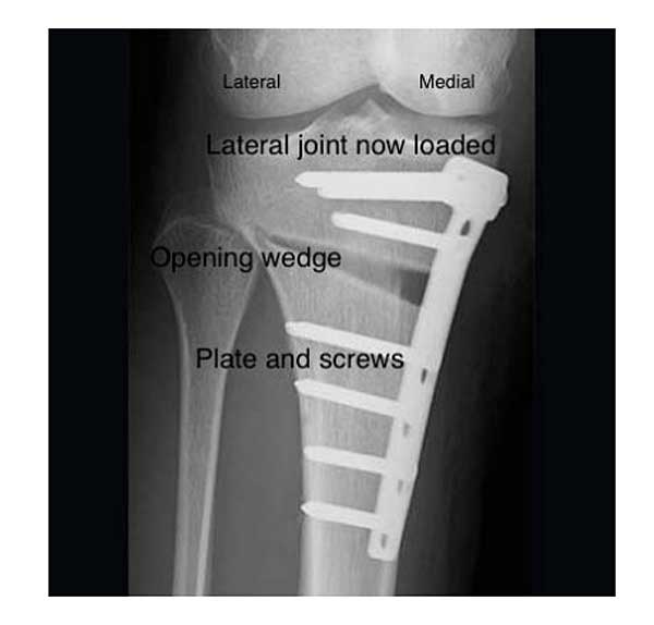 image of Corrective High Tibial Osteotomy showing lateral joint now loaded, opening wedge and plate and screws bone in place